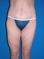 Body Lift