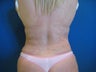 Tummy Tuck