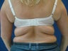 Tummy Tuck