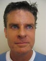 Laser Resurfacing
