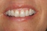Gum Lift and Porcelain Veneers
