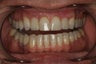 Whitening and Implants