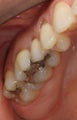 Porcelain Fillings (Inlays and Onlays)