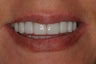 Porcelain Veneers