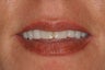 Porcelain Veneers