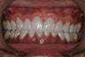 Porcelain Veneers