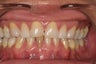 Porcelain Veneers