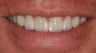 Porcelain Veneers