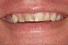 Porcelain Veneers