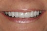 Porcelain Veneers