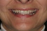 Porcelain Veneers
