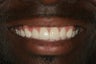 Porcelain Veneers