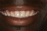 Porcelain Veneers