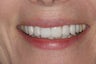 Porcelain Veneers