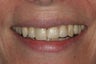 Porcelain Veneers