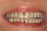 Porcelain Veneers