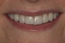 Porcelain Veneers