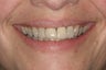 Porcelain Veneers
