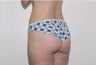 Bodylift
