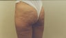 Bodylift