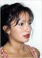 Rhinoplasty