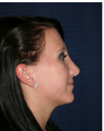 Rhinoplasty