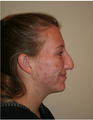 Rhinoplasty