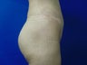 Buttock Implants
