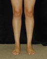 Calve Implants - Front View