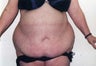 Tummy Tuck