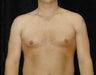 Gynecomastia - Male Breast Reduction