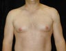 Gynecomastia - Male Breast Reduction