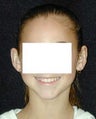 Otoplasty - Ear Surgery