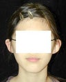 Otoplasty - Ear Surgery