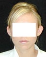 Otoplasty - Ear Surgery