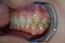 Extreme goofy teeth with gaps treated with Invisalign