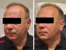 Correction of nasolabial folds and marionette lines with hyaluronic acid filler (eg. Juvederm / Restylane / Perlane)