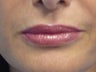 Juvederm Lips