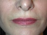 Juvederm Lips