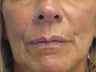 Juvederm Nasolabial folds and Lips