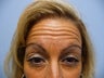 Dysport Forehead