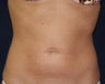 Smart Lipo