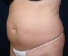 Smart Water Lipo