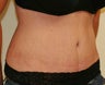 Tummy Tuck