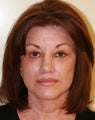 Facelift and Rhinoplasty