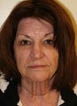 Facelift and Rhinoplasty