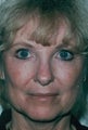 Laser resurfacing