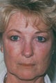 Laser resurfacing
