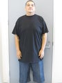 Gastric Bypass