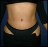 Tummy Tuck